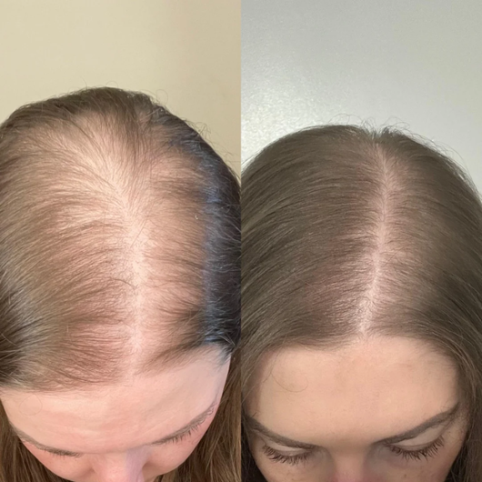 Plexora™ Micro-Mist Hair Growth Spray