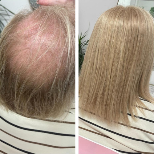 Plexora™ Micro-Mist Hair Growth Spray