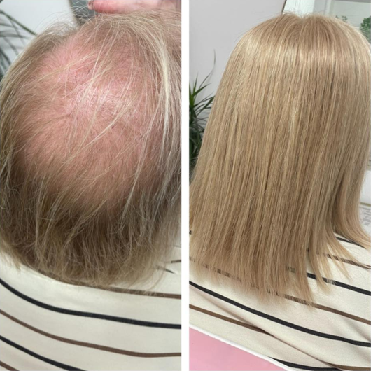 Plexora™ Micro-Mist Hair Growth Spray